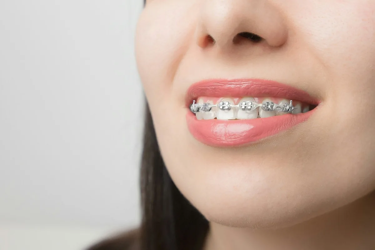 Detalle de una sonrisa con brackets colocados