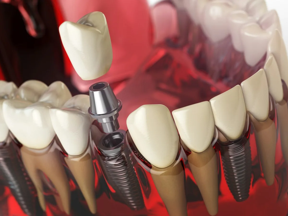 Modelo que muestra un implante dental colocado en el hueso
