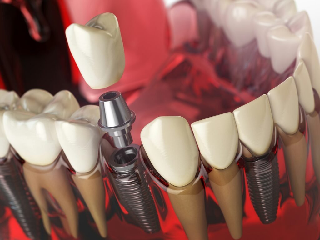 Tooth implant in the model human teeth, gums and denturas. Denta
